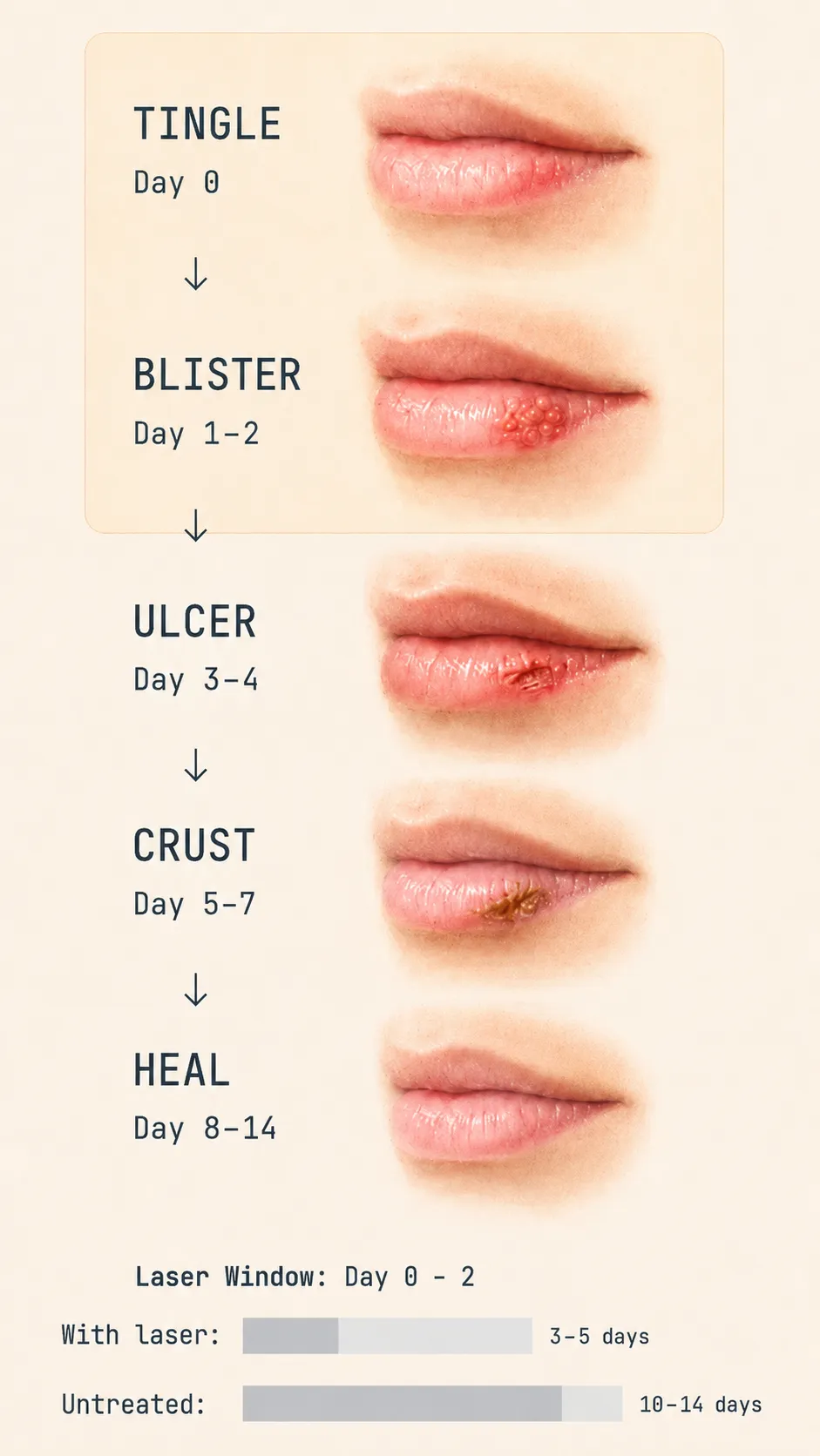 The five stages of a cold sore on the lip, from tingle to healed, with the laser treatment window highlighted at days 0 to 2. Includes a healing-time comparison showing 3 to 5 days with laser versus 10 to 14 days untreated.