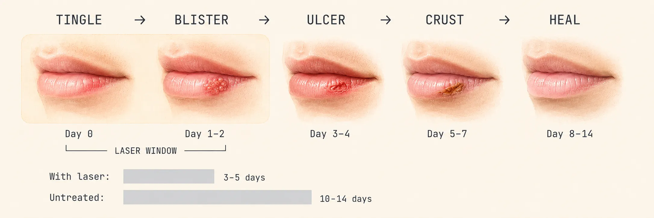 The five stages of a cold sore on the lip, from tingle to healed, with the laser treatment window highlighted at days 0 to 2. Includes a healing-time comparison showing 3 to 5 days with laser versus 10 to 14 days untreated.